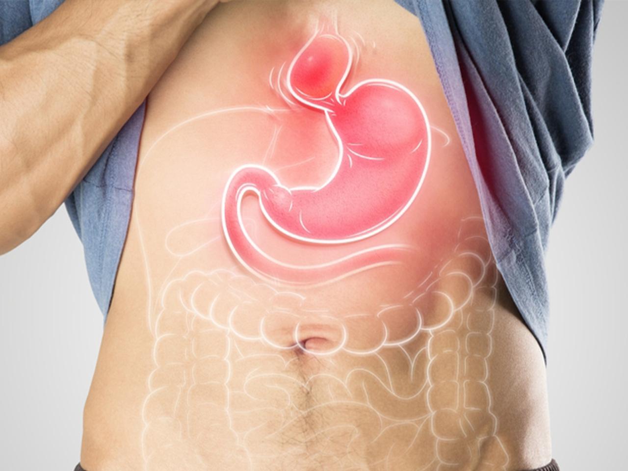 فتق الحجاب الحاجز وأعراضه وتشخيصه وعلاجه