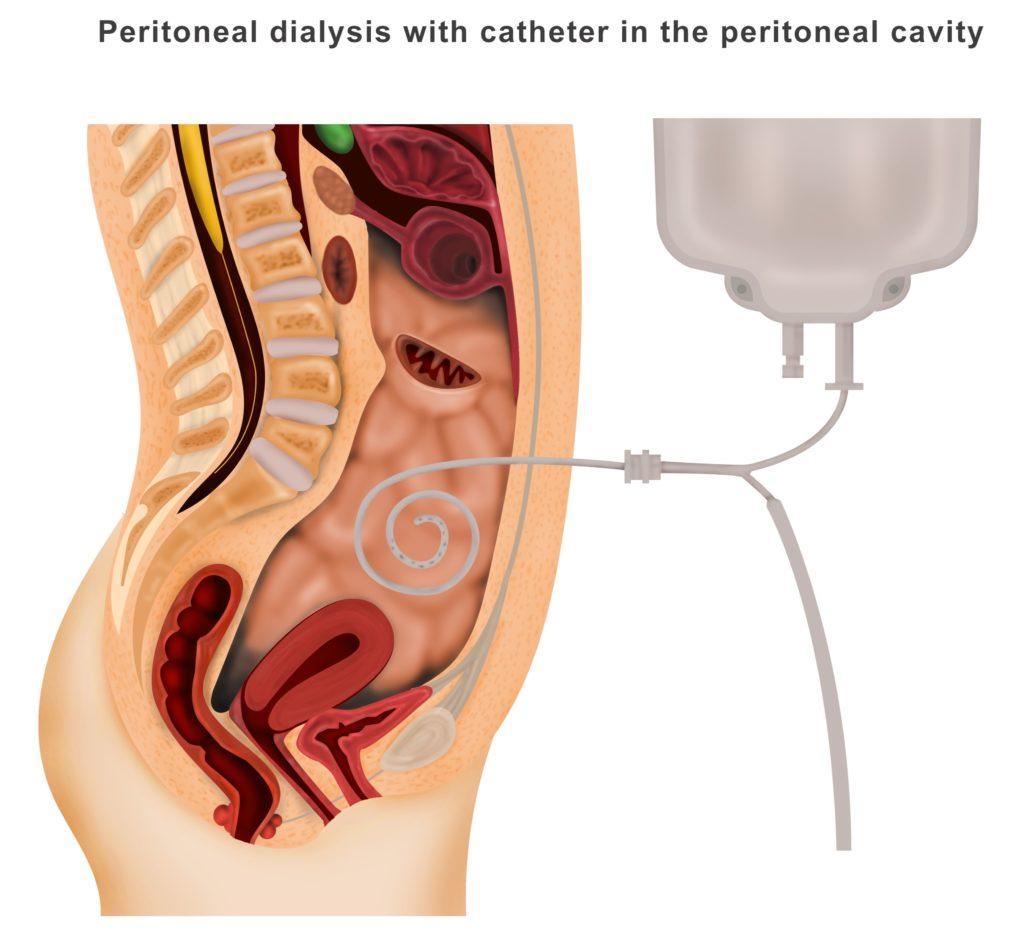 Dialysis Access Dialysis Access