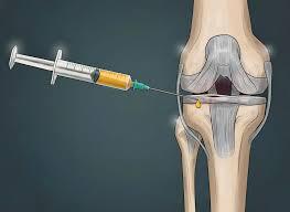 علاج تمزق الغضروف الهلالي في الركبة بدون جراحة مع طبيب عظام