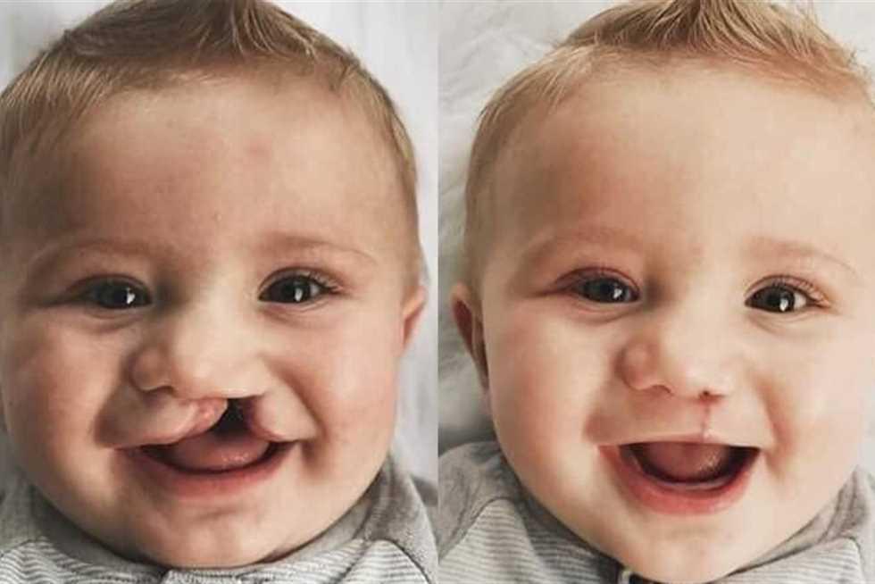 علاج الشفة الأرنبية وسقف الحلق في المعادي