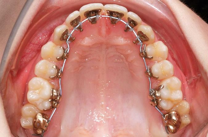 رحلة تقويم الأسنان خطوة بخطوة