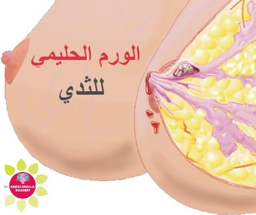 الأورام الليفية في الثدي