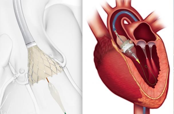 علاج التهابات صمامات القلب