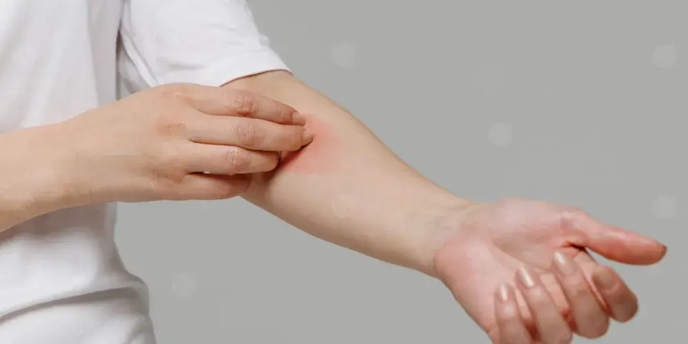 مريض يعانى من حساسية طعام تظهر عليه أعراض جلدية وتنفسية.