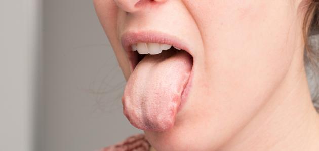 طبقة بيضاء على اللسان عند الاستيقاظ وأسبابها الصحية