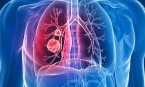 جهاز تنفس للكشف المبكر عن سرطان الرئة