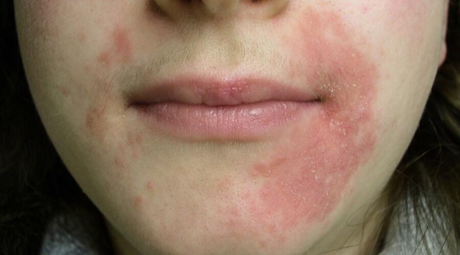 وصفات طبيعية لعلاج التهاب الجلد حول الفم في فصل الشتاء