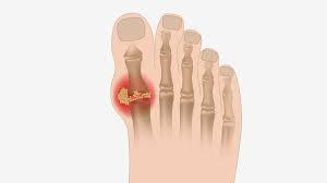 خضراوات طبيعية تساعد على خفض حمض البوليك خلال شهر