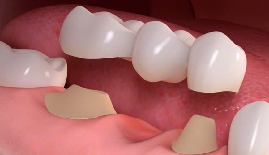 Dental Prosthetics Fixed and Removable Prosthetics