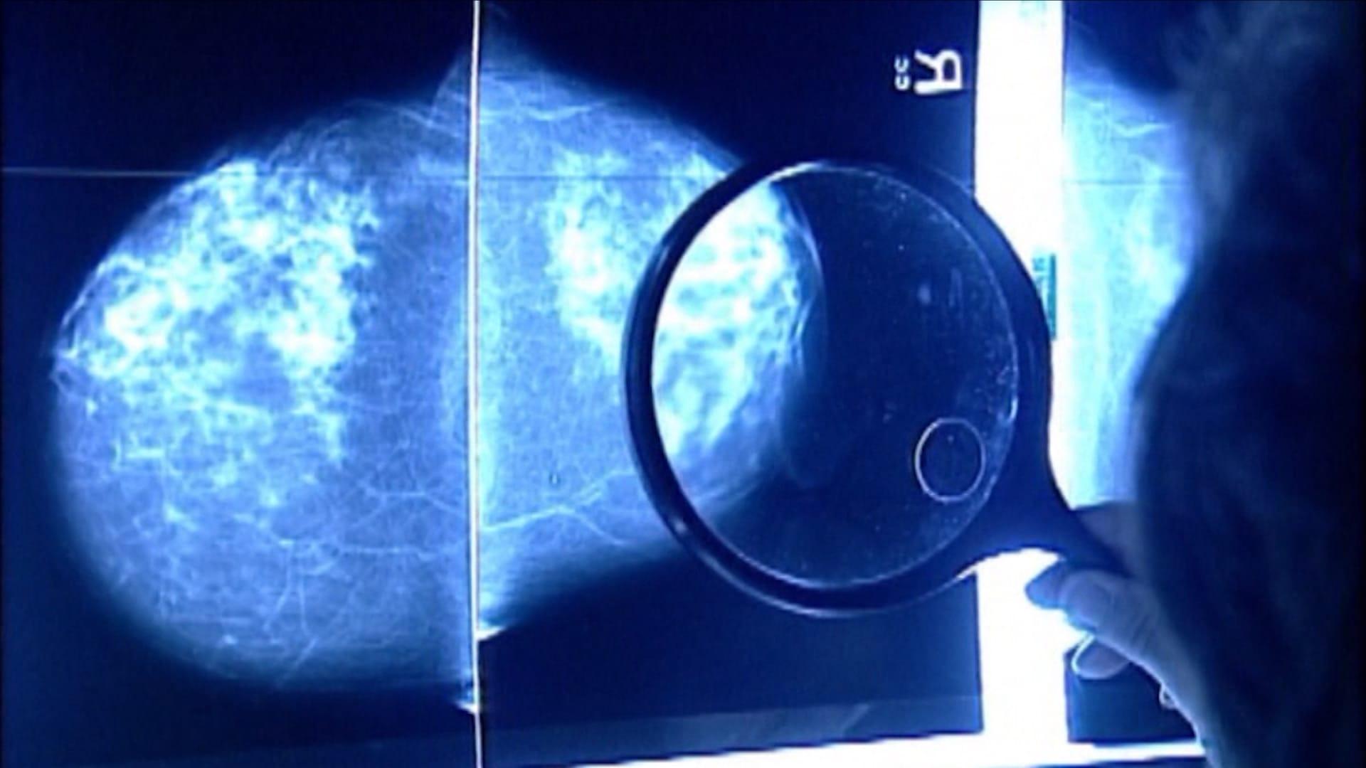 دواء تروديلفي Trodelvy الأمريكي يظهر فعالية كبيرة في تقليل خطر تطور سرطان الثدي العدواني بنسبة 38%.