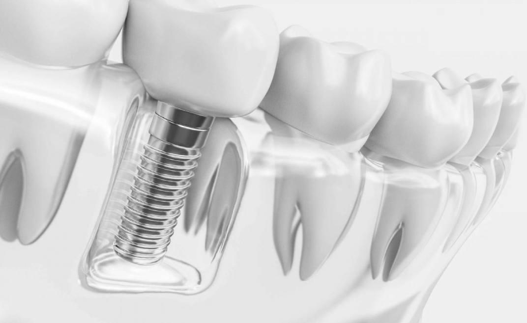 Painless Dental Implants Dental Implants