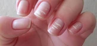 صورة توضح أعراض نقص الحديد مثل هشاشة الأظافر وبرودة القدمين