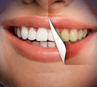 Teeth Whitening Teeth Whitening