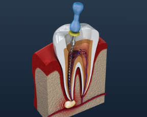 Root Canal Treatment Root Canal Treatment
