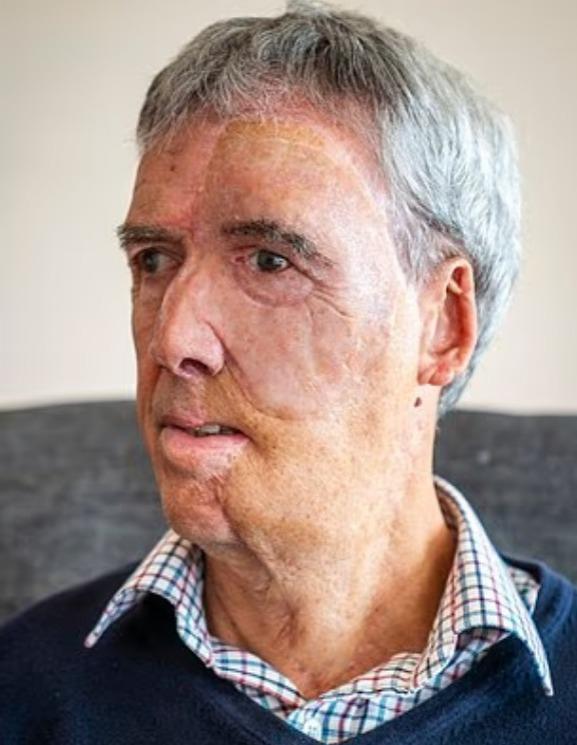 رجل بريطاني فقد نصف وجهه يستعيد ملامحه بتقنية الطباعة ثلاثية الأبعاد بعد حادث مروري