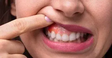 تسوس الأسنان يرفع خطر السكتة الدماغية