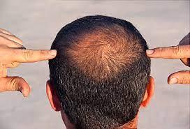 مصل طبيعي جديد يعيد نمو الشعر خلال 20 يومًا فقط وفقًا لدراسة علمية من جامعة تايوان