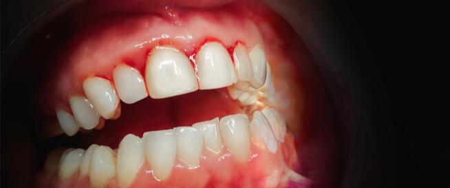 Teeth Cleaning and Gum Care Teeth Cleaning