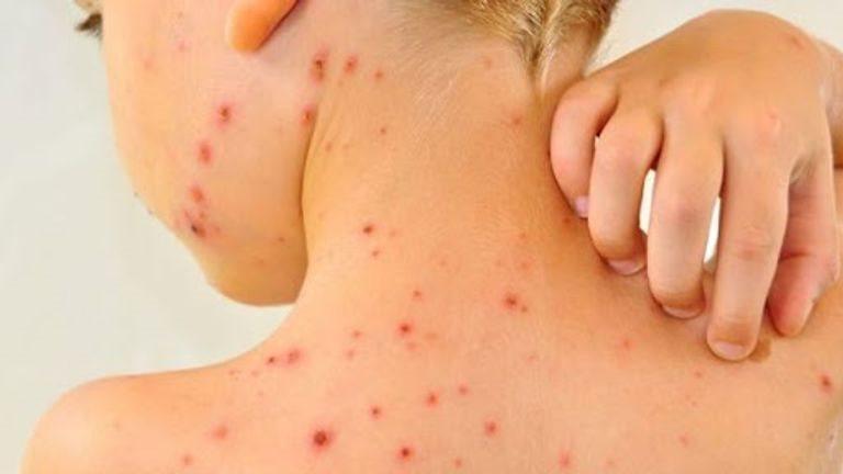 طلاب مدرسة في المنوفية أثناء متابعة الحالات المصابة بالجديري المائي