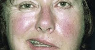 مريض يعاني من تدلي جانب الوجه بسبب شلل العصب السابع الناتج عن التهاب أو سكتة دماغية