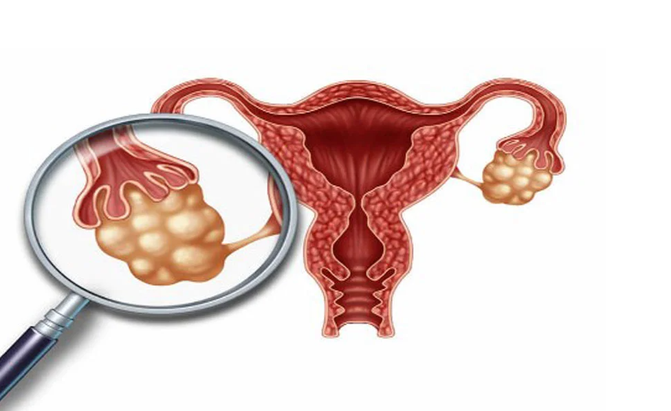 Polycystic Ovary Syndrome Polycystic Ovary Syndrome symptoms and medical evaluation