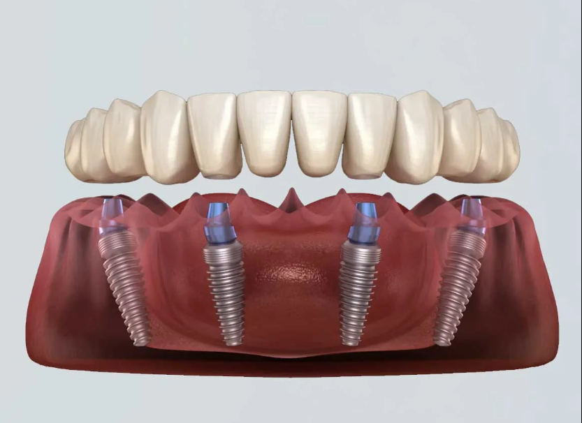 Dental Implants in Nasr City Dental Implants in Nasr City at Bianca Dental Clinic