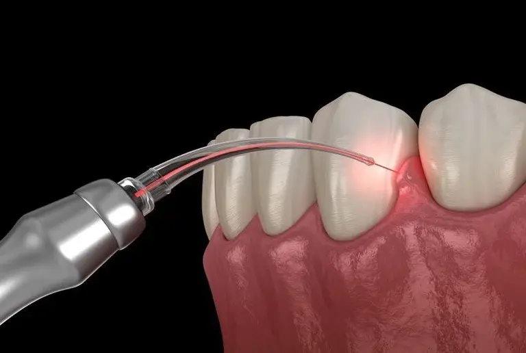 أمراض اللثة وعلاج انحسار اللثة في دمياط