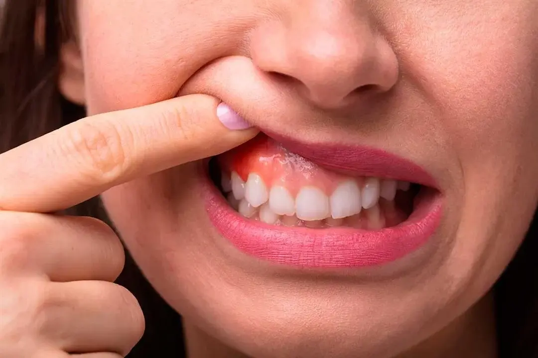 علاج اللثة والتجميل اللثوي