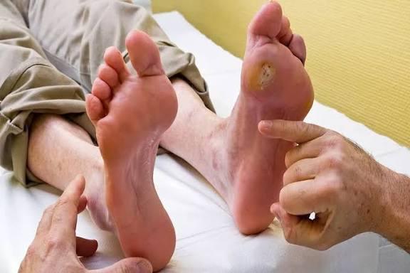 علاج القدم السكري