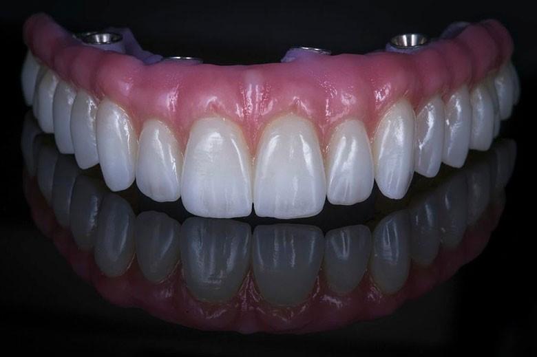 Dental restorations and dentures for replacing missing teeth