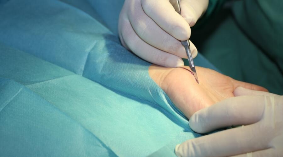تسليك اختناق العصب بالميكروسكوب في طنطا