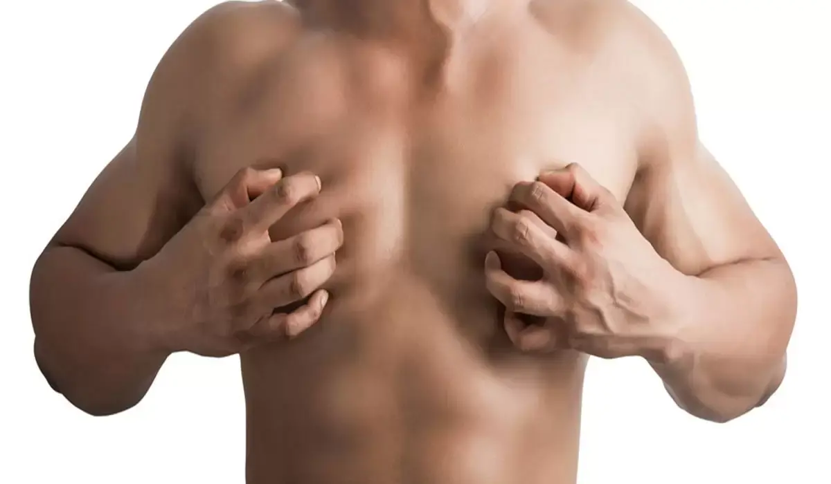 التثدي لدى الرجال (Gynecomastia)؟