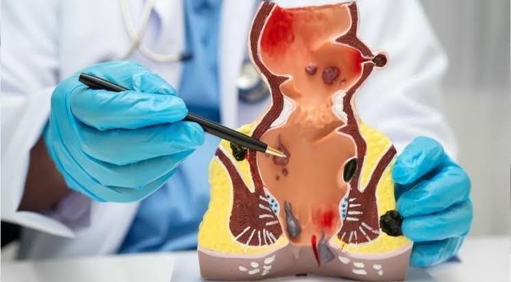 Symptoms and warning signs of rectal bleeding