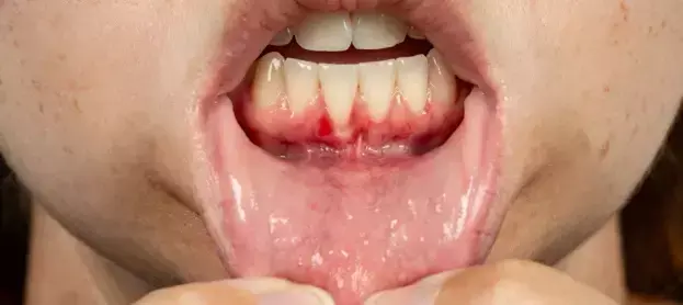 أمراض اللثة وانحسار اللثة وزراعة العظم