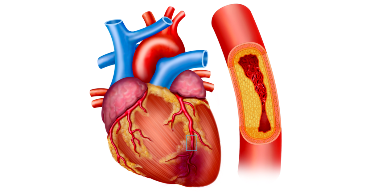 Coronary artery bypass surgery evaluation and coronary artery disease assessment