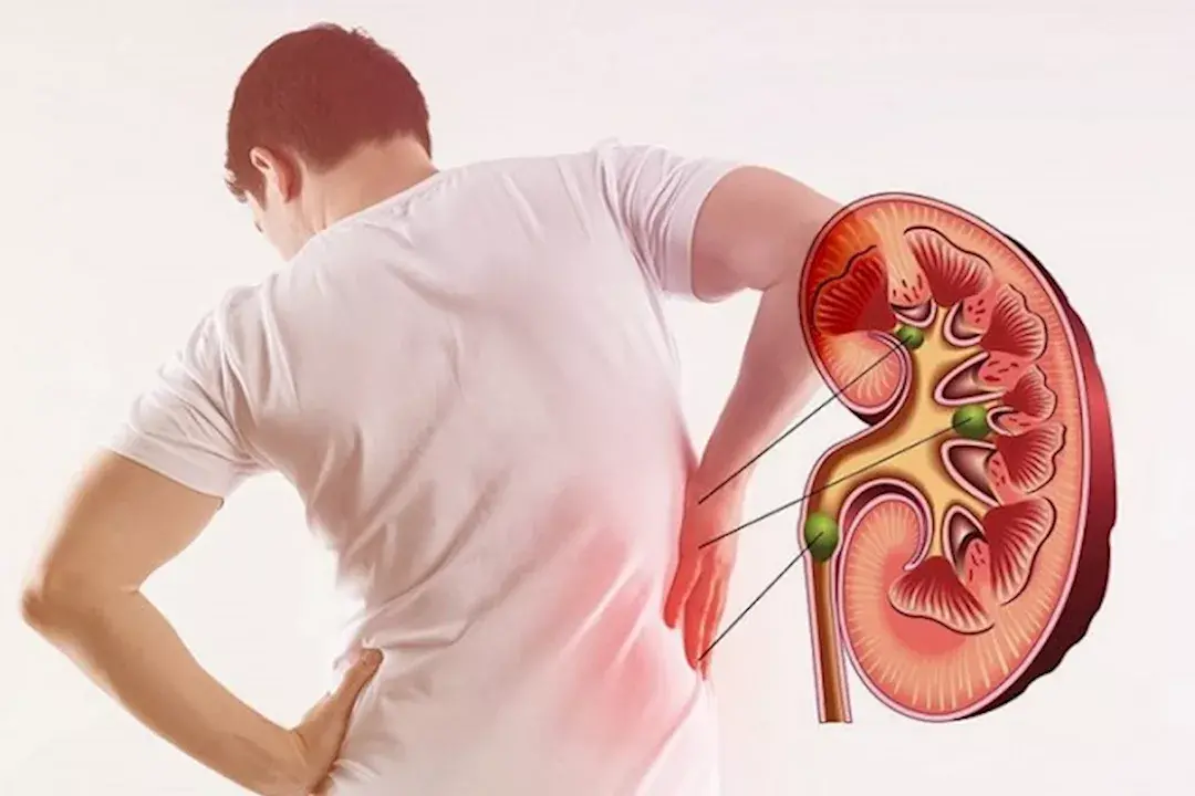 حصوات الكلى: الأعراض والأسباب وطرق العلاج