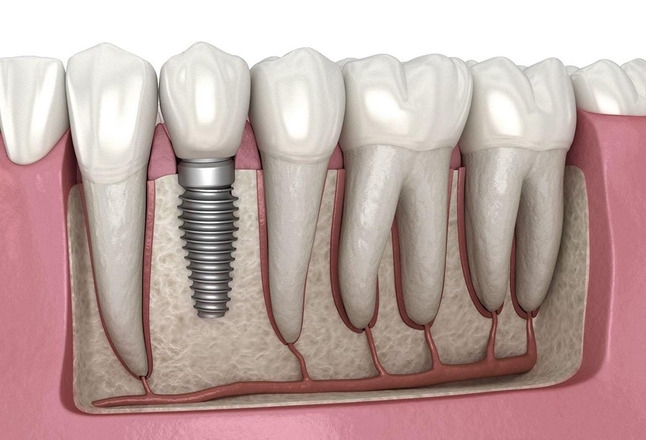 Dental implants in Heliopolis Cairo