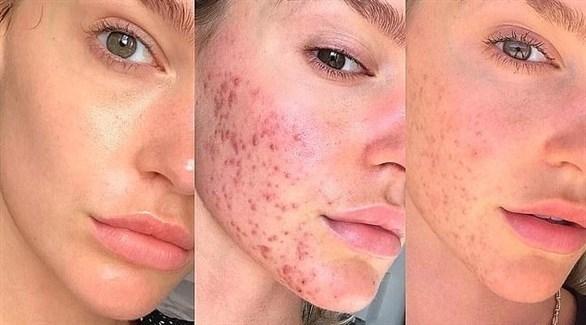 Dermatologist in Maadi Dr. Magy Fawzy dermatologist in Maadi treating facial acne and cosmetic acne