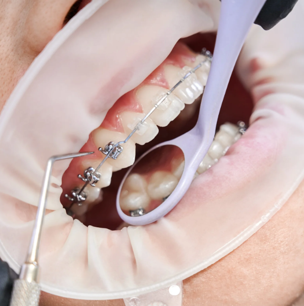 Orthodontic treatment in Gharbia and Basyoun