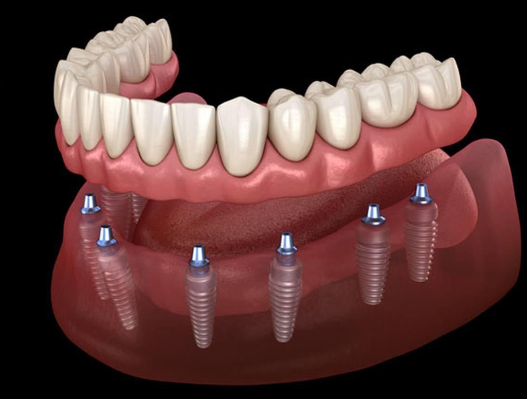 Dental Implants in Downtown Cairo Dental Implants in Downtown Cairo with Dr. Ahmed Khaled Abu Zeid