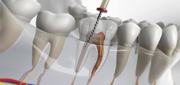 علاج الجذور والأعصاب