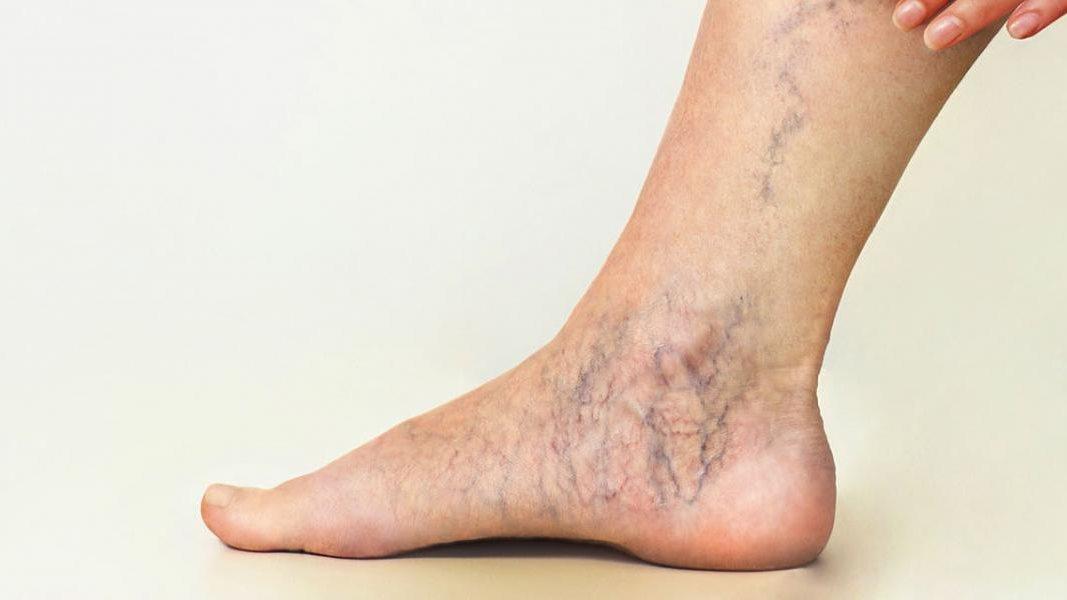 علاج الدوالي في شبرا الخيمة