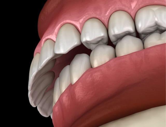 علاج اعوجاج الفك والأسنان