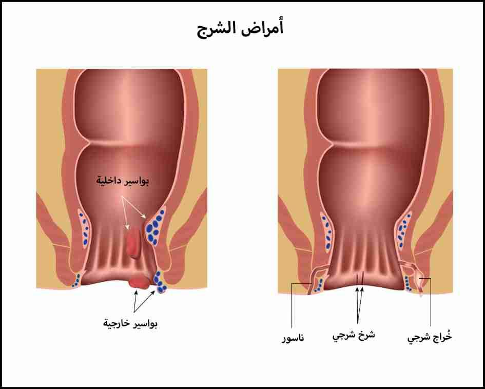 الشرخ الشرجي الحاد والمزمن