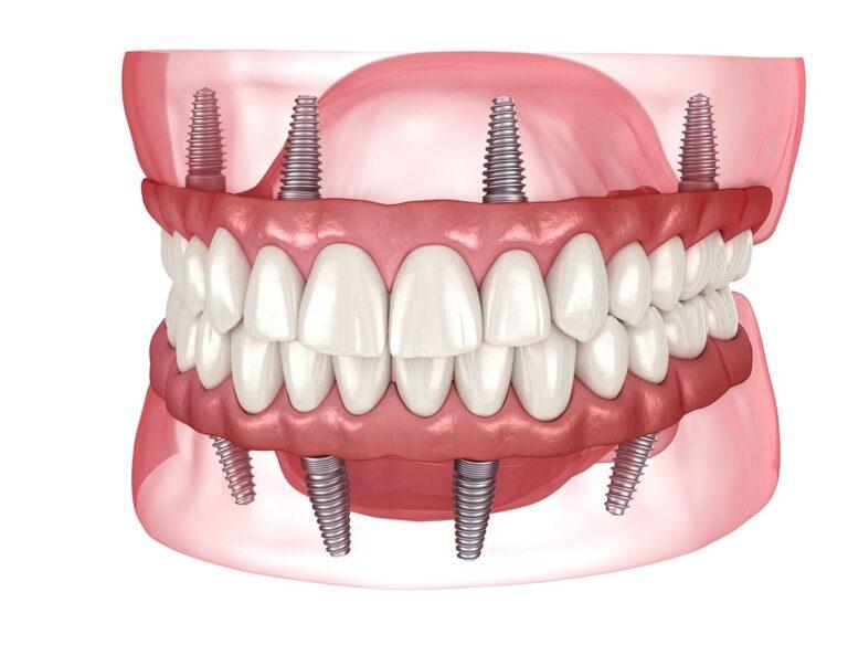 Full arch dental implants and All-on-4 treatment