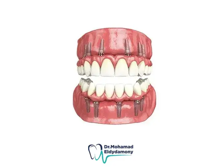زراعة الفكين في عيادة داماس لطب الأسنان