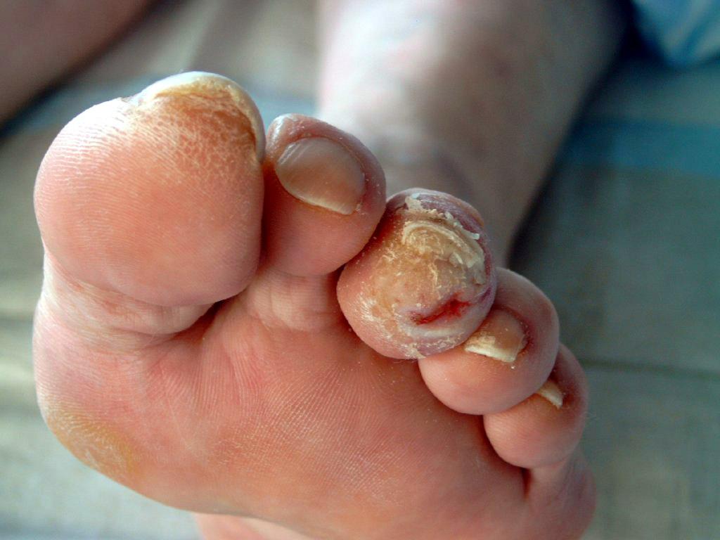 علاج القدم السكري في الغردقه