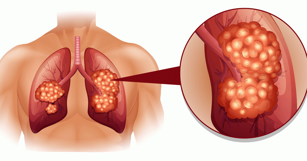 Alecensa 150 mg أليكيسا لعلاج سرطان الرئة وطريقة استخدامه