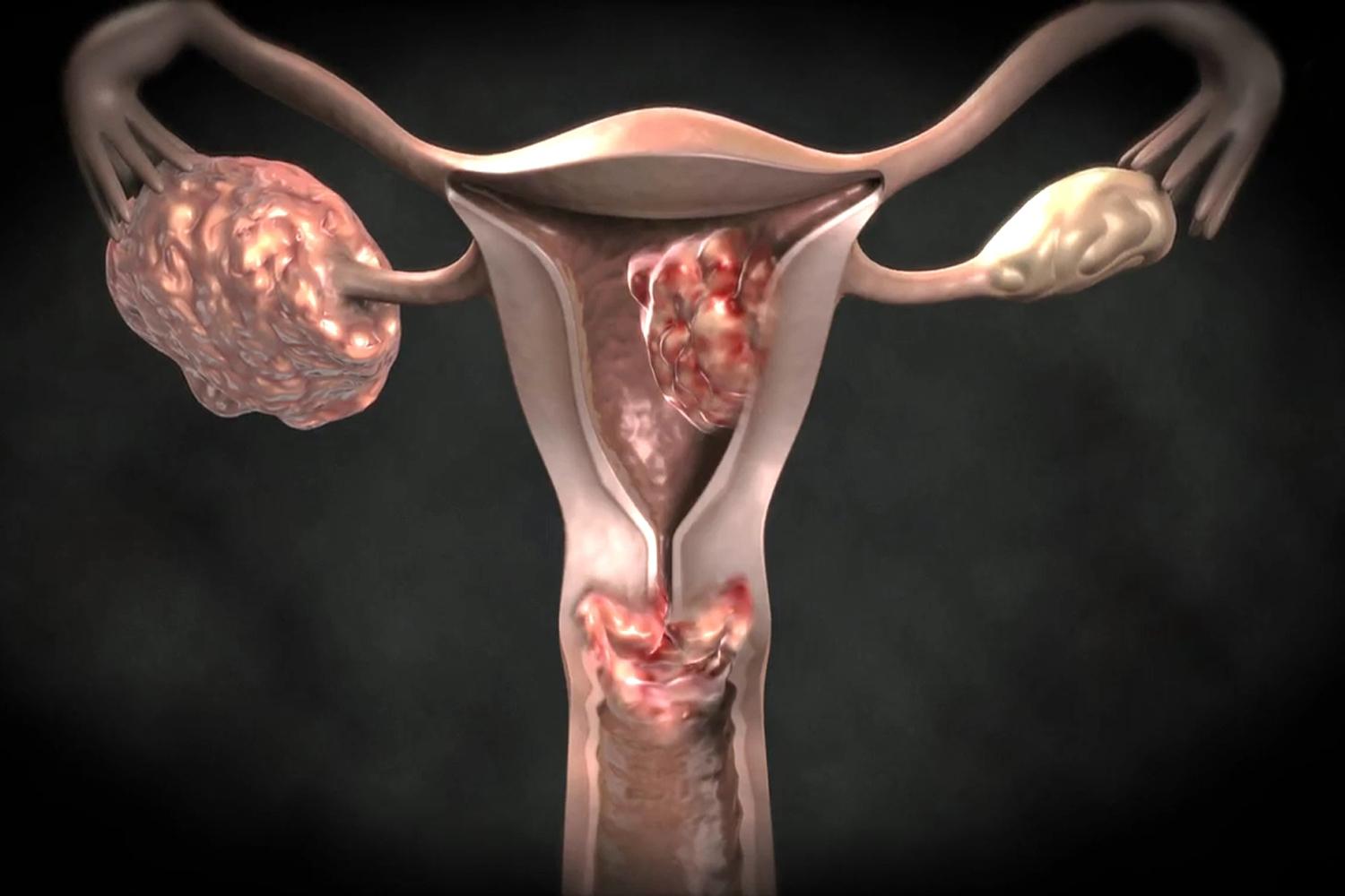 Cervical Cancer Cervical cancer symptoms and cervical tumors