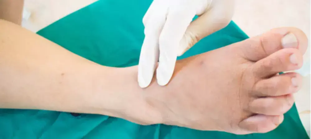 القدم السكري وأحدث طرق العلاج